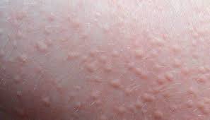 A reaction to a new medicine or food. Cholinergic Urticaria Symptoms Treatment And Causes