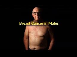 Find out more about male breast cancer symptoms and the treatments that are available. Male Breast Cancer Symptoms Causes Symptoms And Pictures Of Breast Cancer In Men Youtube
