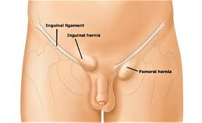 Pinpoint signs and symptoms in the male groin region using medicinenet's illustrative guide. Lump In Groin Female And Male Causes And Diagnosis