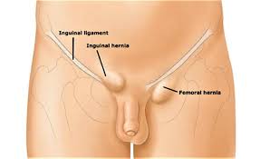 Plugged sweat glands that become infected.boils groin area.toms, causes, treatmentsee all results for this questionhow long does it take for boils. Lump In Groin Female And Male Causes And Diagnosis