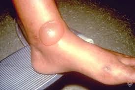 What's more, diabetes is linked to a condition called peripheral arterial disease (pad), which lessens blood flow to your legs and feet. Diabetes 12 Warning Signs That Appear On Your Skin