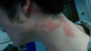 Image result for bedbugs bites