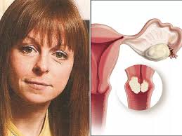 11 myths about 'silent killer' gynaecological cancers and the warning signs  that can help save lives