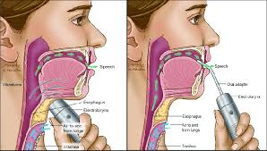 a: Electrolaryngeal speech -necktype; 4b: Electrolaryngeal speech...