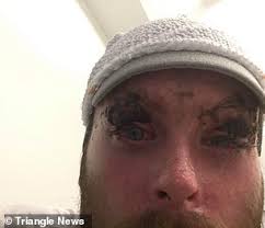 A man who suffered 70 per cent burns in a caravan fire reveals he's glad  that it happened