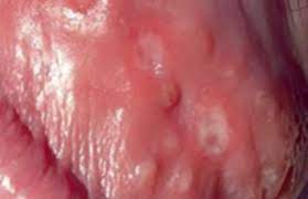 Maybe you would like to learn more about one of these? Ulcerations Genitales Ne Pas Meconnaitre Le Chancre Mou Dermatologie Pratique