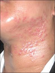 The causes of rash on face. Monomorphic Rash On The Neck Photo Quiz American Family Physician