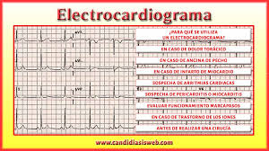 This noninvasive test shows your heart's electrical patterns and can in many cases, myocarditis improves on its own or with treatment, leading to a. Pruebas Y Examenes Electrocardiograma