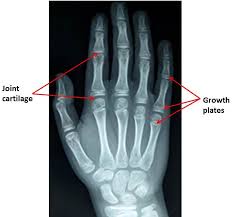 Image result for Hand Growth Plates