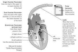 Types of pacemakers for bradycardia. Pin On Cardiac Notes