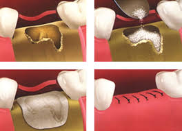 Fees for pulling teeth, by extraction type: Bone Grafting Morgan Lemke Periodontics Dental Implants