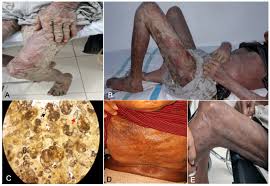 Image result for scabies norvegica