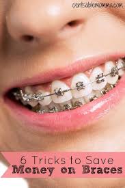6 Tricks To Save Money On Braces Saving Money Braces Getting Braces