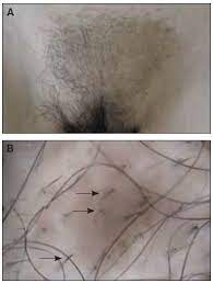 If you're experiencing pubic hair loss, definitely let your doctor know. Racgp Patchy Hair Loss On The Pubis A Case Study