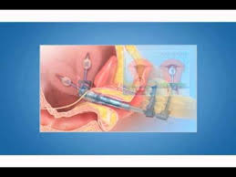 Comparing two uterine manipulators during total. Rumi Uterus Manipulator Youtube