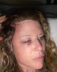 Chemo recovery is a challenge up in my brain but the rest of me gives  double middle fingers to cancer by running 19 miles yesterday and 11 miles  today. I'm damn proud