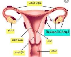 بطانة الرحم المهاجرة والحجامة حجامة نسائية وهران facebook