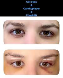 New The 10 Best Eye Makeup Ideas Today With Pictures Cat Eyes Canthoplasty Cheek Lift Cateyes Eyebrow Lift Temple Eye Makeup Cool Eyes Eyebrow Lift