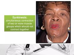 Facial paralysis reconstruction