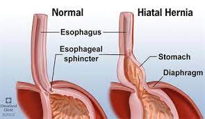 Just above the stomach, the. Hiatal Hernia
