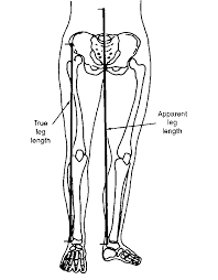 Image result for Functional Leg Length Discrepancy