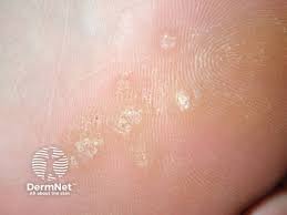 Image result for verrucae filiformes