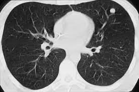 It is one of the most common benign tumors of the lung and accounts for ~8% of all lung neoplasms and 6% of solitary pulmonary nodules. Https Www 2013 Roentgenkongress De Media Document 3189 Rk Sp 403 1 Diederichs Pdf