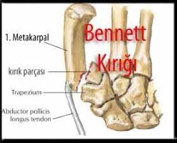 El Bilegi Kiriklari Distal Radius Ulna Kiriklari Fizyoo Elsa Fizyoterapi