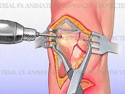 Tibial Plateau Fracture With Metal Plate Fixation Tibial Plateau Fracture Shoulder Rehab Fracture