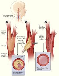 The arteries in neck that supply blood to the brain are called carotid arteries. Department Of Surgery Carotid Artery Disease