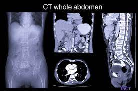 The normal pricing for these individual scans is listed below. Abdominal Ct Scan Cost With Contrast Results Radiation Factdr
