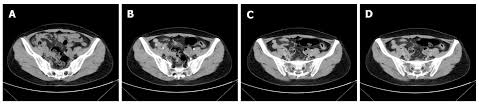 The ct value refers to the number of cycles after which the virus can be detected. A6wr8rmx44npzm