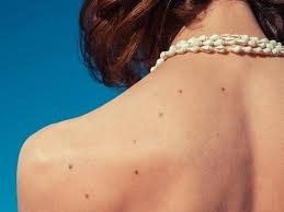 Chto Oznachayut Rodinki Na Vashem Tele Mk Chelyabinsk