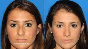 Check spelling or type a new query. Rhinoplasty Before And After Photos