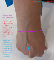 Image result for Peripheral IV Access