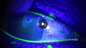 Image result for Seidel Test