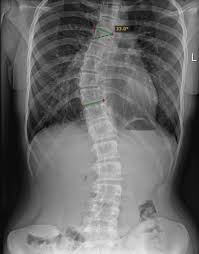 متى تكون زاوية كوب أكثر عرضة للتدهور مع العمر؟