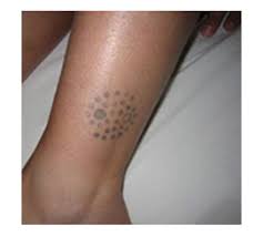 We offer laser tattoo removal in birmingham, leeds and london, and all of our laser tattoo removal procedures are conducted by professionally trained medical. Tattoo Removal Tattoo Removal London
