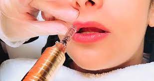 How to reduce swelling after lip fillers. Hyaluronic Needless Lip Filler Vjazzy Wellness Las Vegas Nv