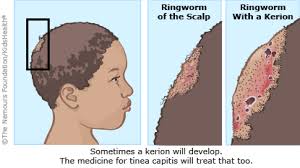 I was one of the skeptics. Ringworm For Teens Nemours Kidshealth