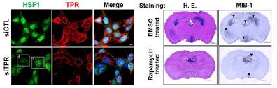Brain cancer can change a person's behavior and can be quite deadly. Insights Into The Diagnosis And Treatment Brain Cancer In Children Eurekalert Science News