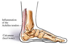 It is also the commonest tendon to rupture. Achilles Tendinopathy Uva Health