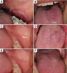 Image result for lichen planus on tongue)