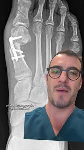 Nanoplasty Bunion Surgery: A Revolutionary Approach