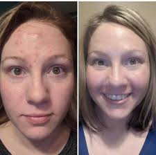 I have cystic acne, blackheads and scarring. I'm also tanned so I would  love to know which products work wonders