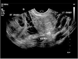 Pelvic venous congestion syndrome is also known as ovarian vein reflux. Gynecology Pelvic Ultrasound Made Easy Step By Step Guide Pocus 101