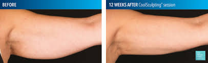 The price of coolsculpting of the arms depends on the size and number of applicators that are needed to properly treat the area. How Much Does Coolsculpting Cost 2021 Coolsculpting Price By Area Arms Chin Abdomen