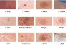 Skin Lesion Chart Skin Ulcer Pressure Ulcer Wounds Nursing