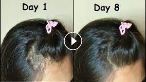 She Regrow Hair In Bald Patches In 1 Week Curry Leaves Hair Oil For Thick Hair Growth Long Hair