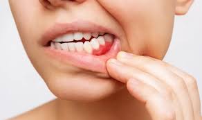 Image result for gum cancer symptoms